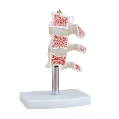 MODELO DE CORTE DE VERTEBRAS EVOLUCIÓN DE OSTEOPOROSIS